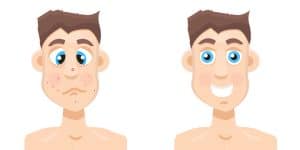 Acne Facts | 7 Interesting Facts About Acne